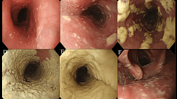 Кандидозный эзофагит (кандидоз пищевода, микоз пищевода, грибковый эзофагит)